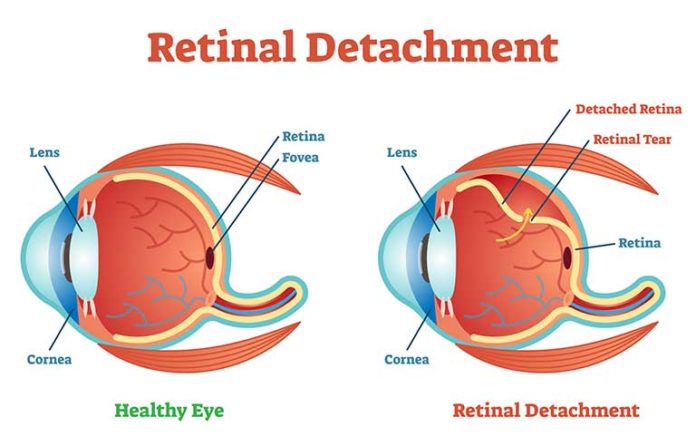 How to Improve the Health of the Retina?